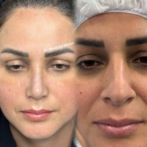 rhinoplasty-10