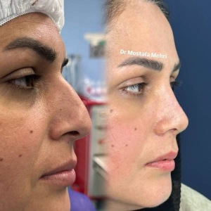 rhinoplasty-11