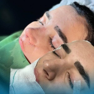 rhinoplasty-13