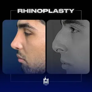 rhinoplasty-14