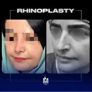 rhinoplasty-15