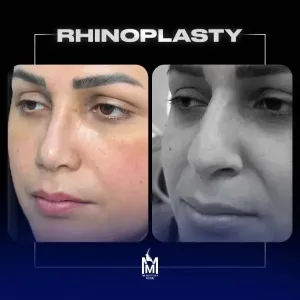 rhinoplasty-17