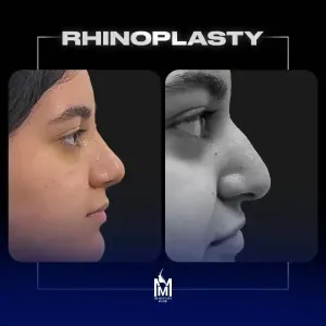 rhinoplasty-18