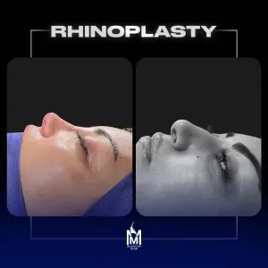 rhinoplasty-21