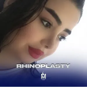 rhinoplasty-23