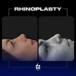 rhinoplasty-29