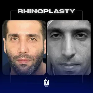 rhinoplasty-30
