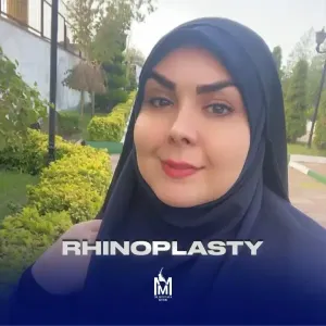 rhinoplasty-34