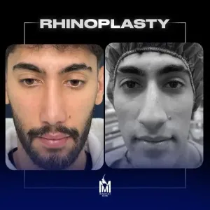 rhinoplasty-35