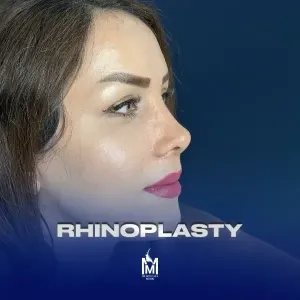 rhinoplasty-36
