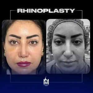rhinoplasty-37