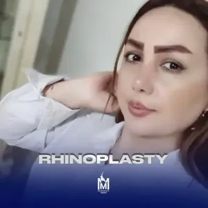 rhinoplasty-41