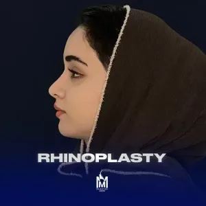 rhinoplasty-43