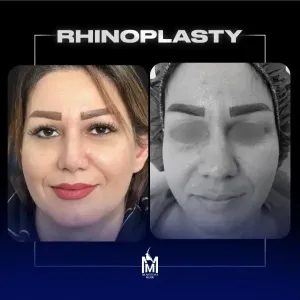 rhinoplasty-45