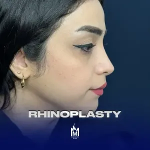 rhinoplasty-46