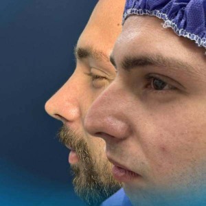 rhinoplasty-7