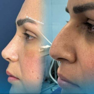 rhinoplasty-8