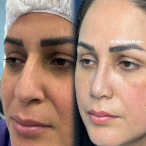 rhinoplasty-9