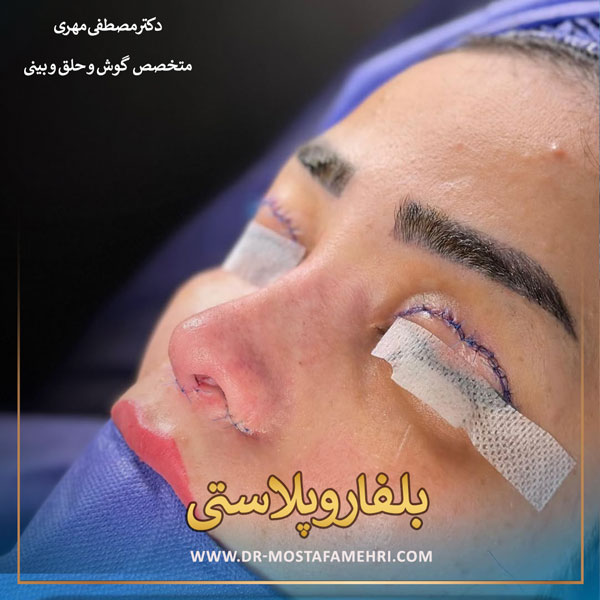 بلفاروپلاستی _ دکتر مصطفی مهری