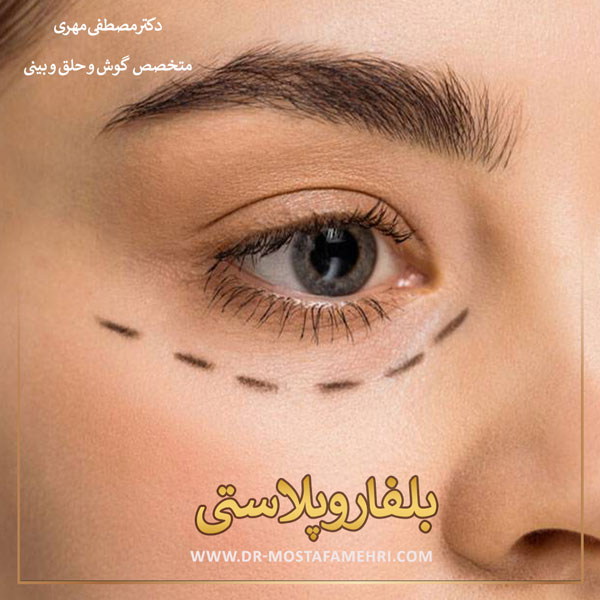 عمل زیبایی پلک _ دکتر مصطفی مهری