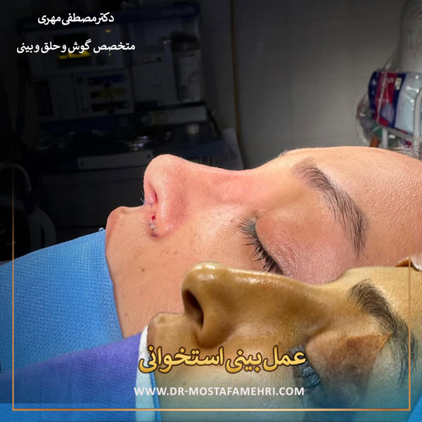 عمل بینی استخوانی _ دکتر مصطفی مهری