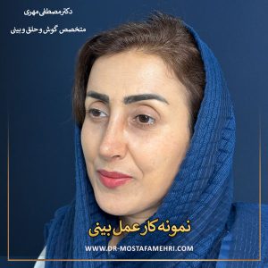 عمل بینی استخوانی _ دکتر مصطفی مهری
