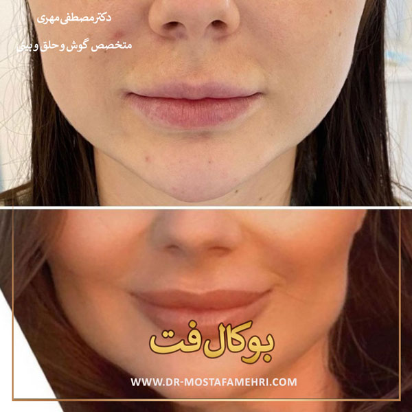 قبل و بعد  بوکال فت _ دکتر مصطفی مهری