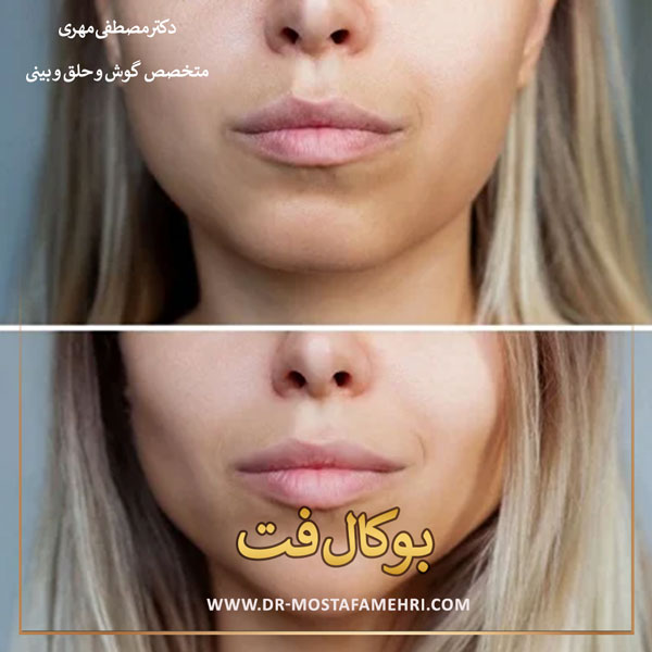 جراحی بوکال فت _ دکتر مصطفی مهری