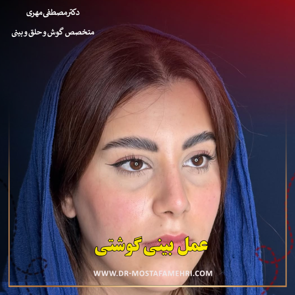 عمل بینی گوشتی _ دکتر مصطفی مهری