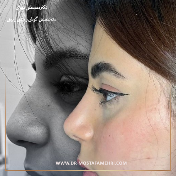 عمل بینی گوشتی _ دکتر مصطفی مهری