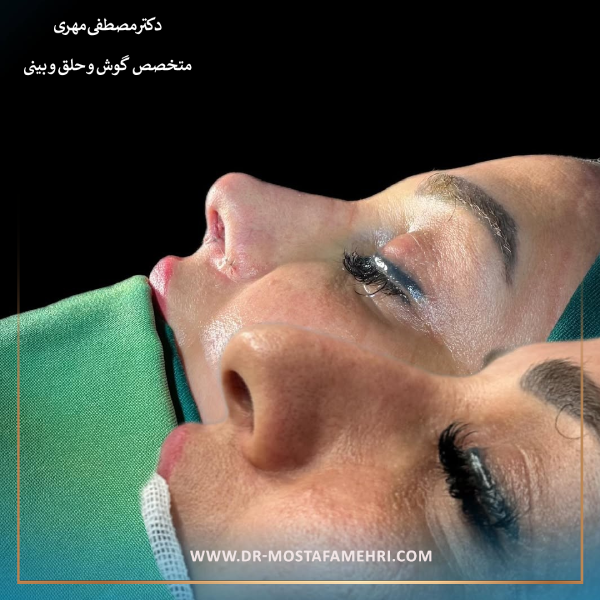 عمل بینی گوشتی _ دکتر مصطفی مهری