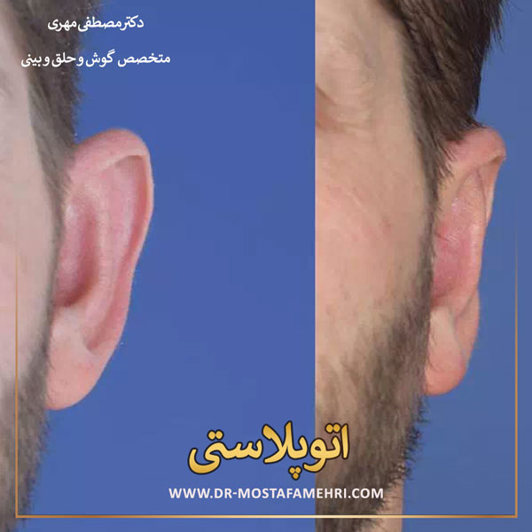 اتوپلاستی _ دکترمصطفی مهری