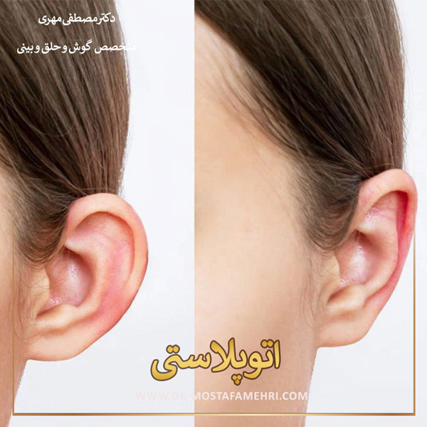 اتوپلاستی _ دکترمصطفی مهری