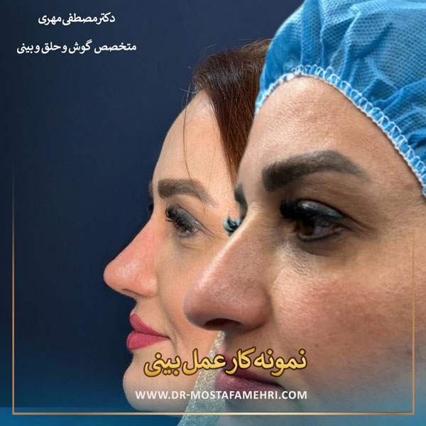 قبل و بعد از عمل بینی _ دکتر مصطفی مهری