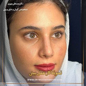 نمونه کار جراح بینی رشت _ دکتر مصطفی مهری