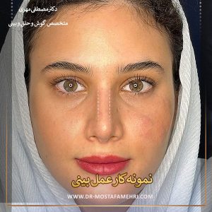 نمونه کار دکتر عمل بینی در رشت _ دکتر مصطفی مهری