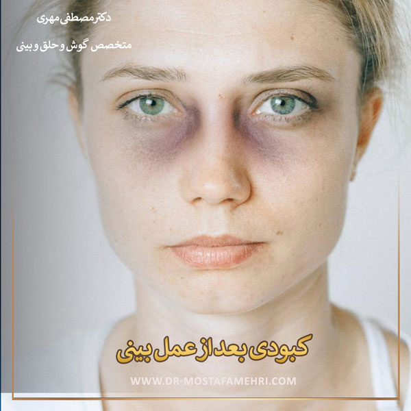 کبودی بعد از عمل بینی _ دکتر مصطفی مهری