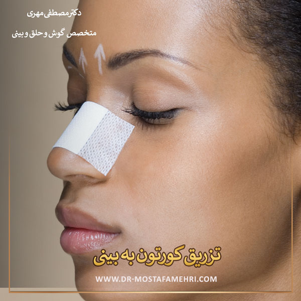 تزریق کورتون به بینی _ دکتر مصطفی مهری