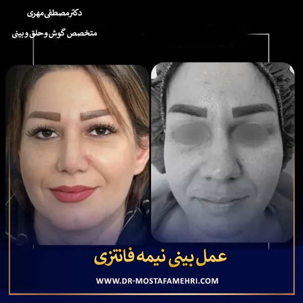 قبل و بعد از عمل بینی نیمه فانتزی