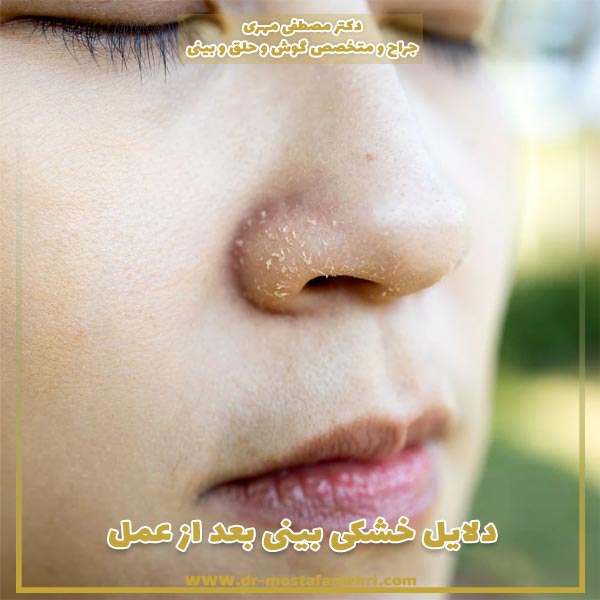دلایل خشکی بینی بعد از عمل + جلوگیری از خشکی بعد جراحی بینی