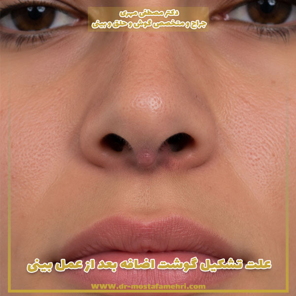 علت تشکیل گوشت اضافه بعد از عمل بینی + درمان گوشت اضافه داخل بینی